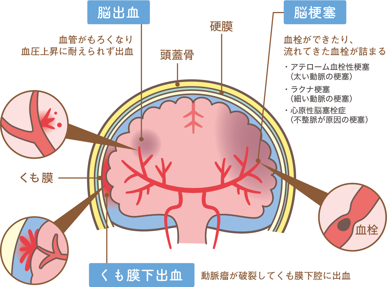 脳出血：血管がもろくなり血圧上昇にたえられず出血　脳梗塞：血栓できたり、流れてきた血液が詰まる　くも膜下出血：動脈瘤が破裂してくも膜下腔に出血