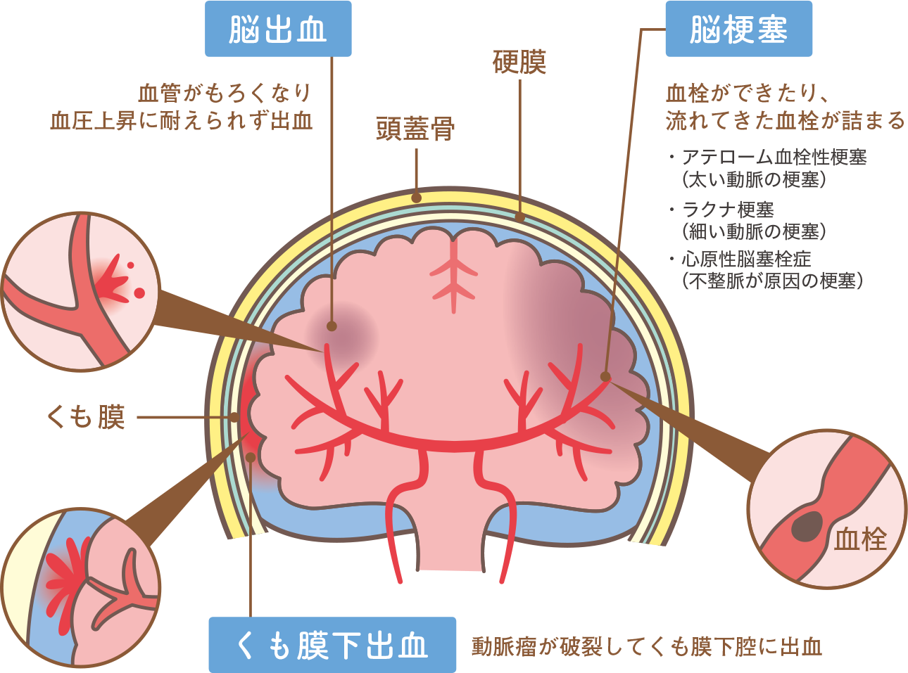 脳出血:血管がもろくなり血圧上昇にたえられず出血 脳梗塞:血栓できたり、流れてきた血液が詰まる くも膜下出血:動脈瘤が破裂してくも膜下腔に出血