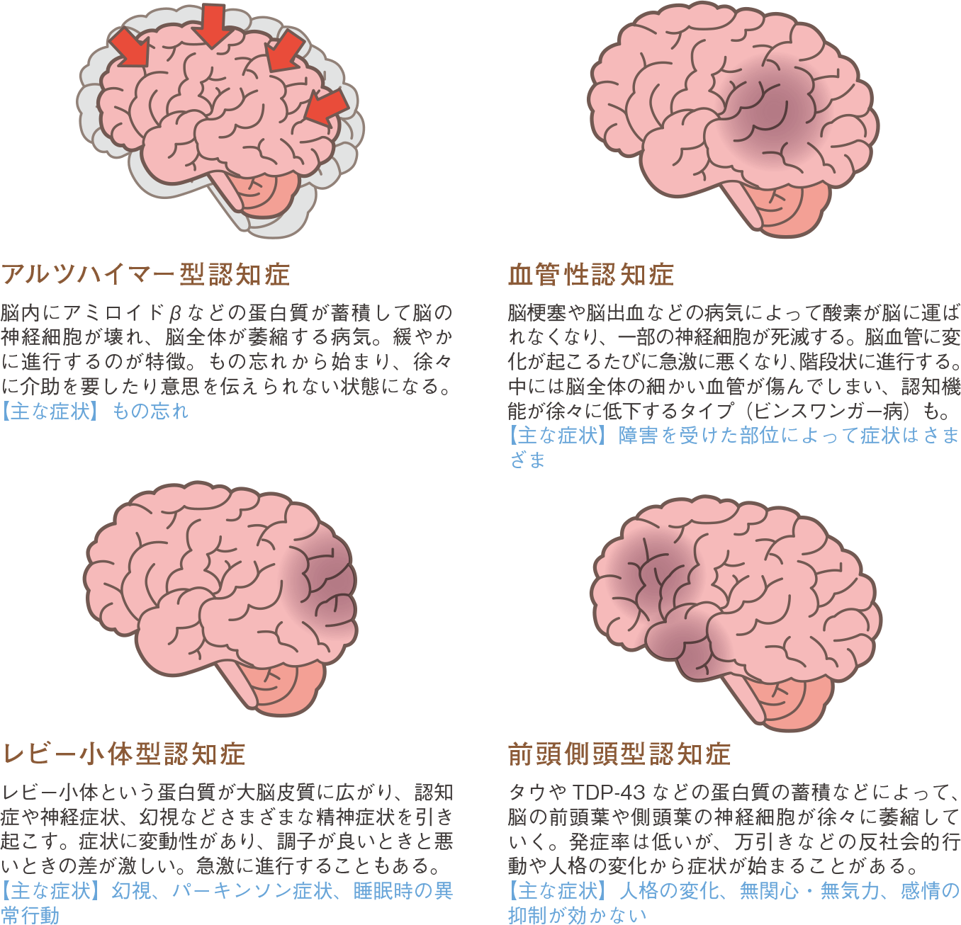 認知症の4タイプ