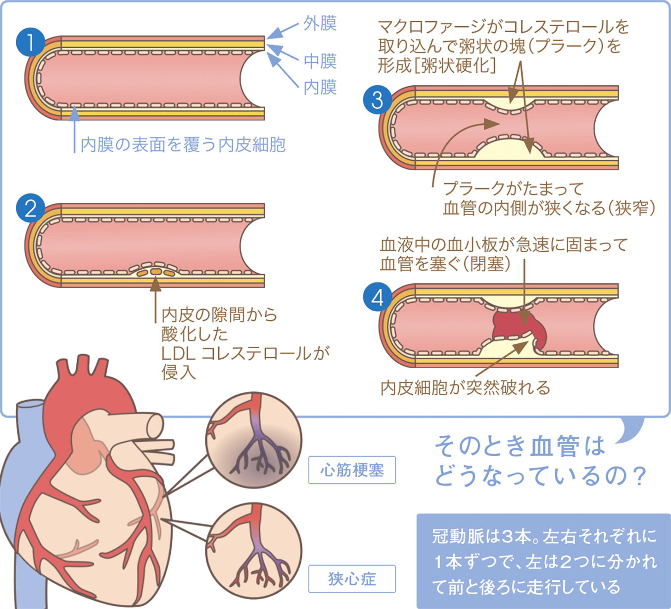 狭心症、心筋梗塞時の血管の状態