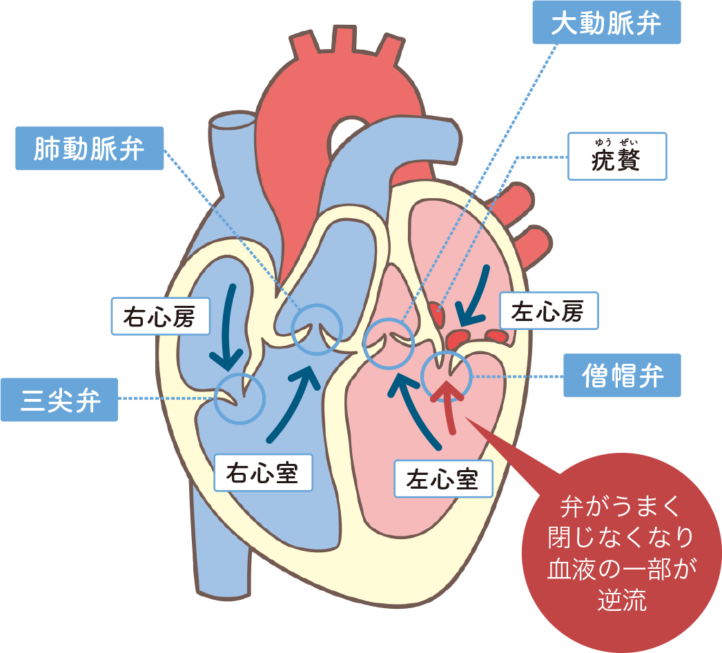 弁膜症の図解