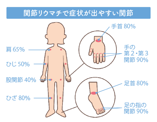 関節リウマチで症状が出やすい関節