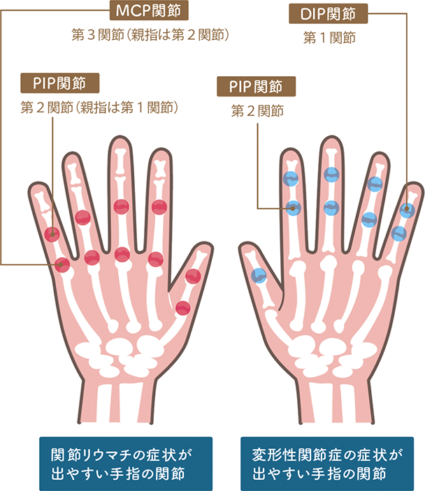関節リウマチ、変形性関節症の症状が出やすい手指の関節