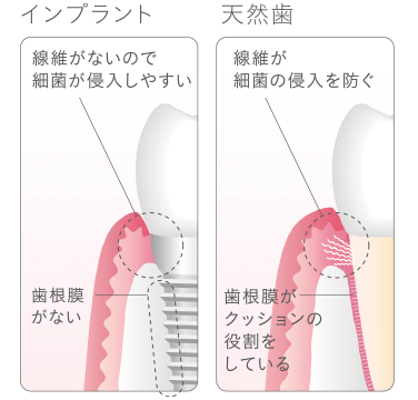 インプラントの歯周病
