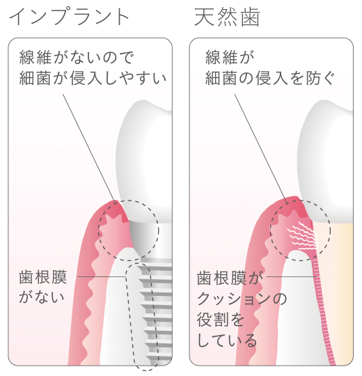 インプラントの歯周病
