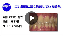 PMTCのポイント症例1「広い範囲に薄く沈着している着色」(再生時間 2:56)