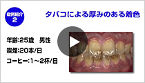 PMTCのポイント症例2「タバコによる厚みのある着色」(再生時間 4:11)