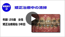 PMTCのポイント症例3「矯正治療中の清掃」(再生時間 1:25)